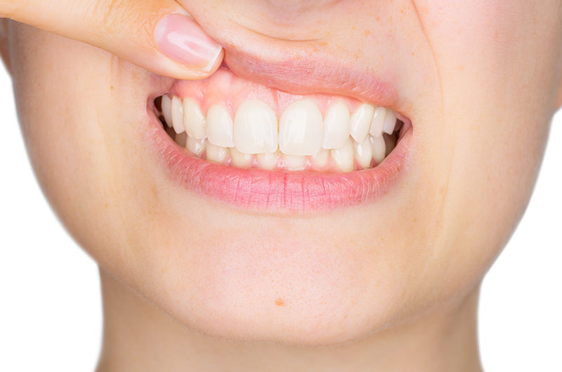 歯周組織を再生・修復する治療